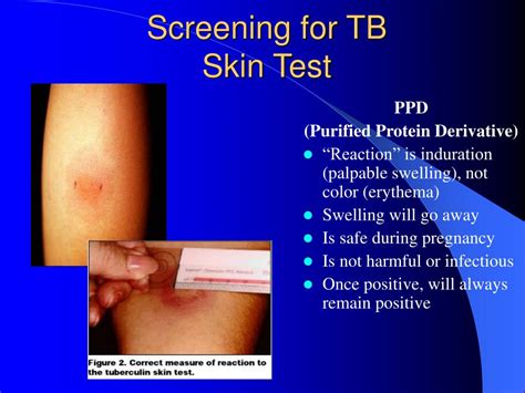 positive ppd images|positive skin tb test image.